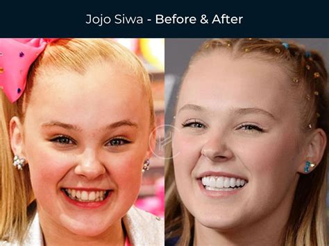 are jojo siwa teeth fake